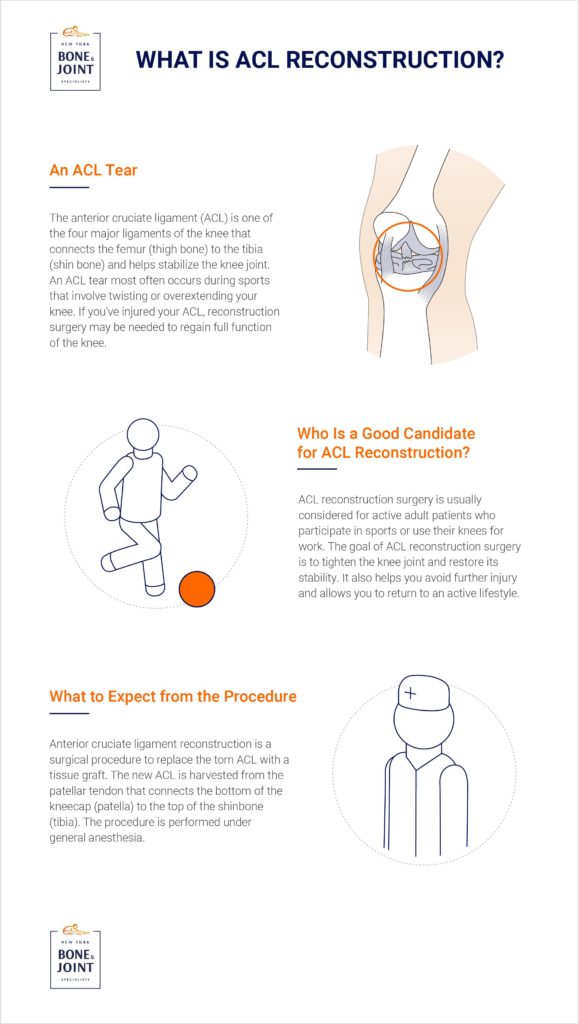 What is ACL Reconstruction