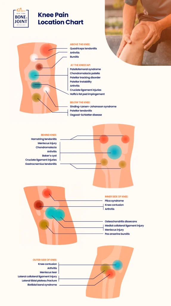 icons depicting the location of different types of knee pain 