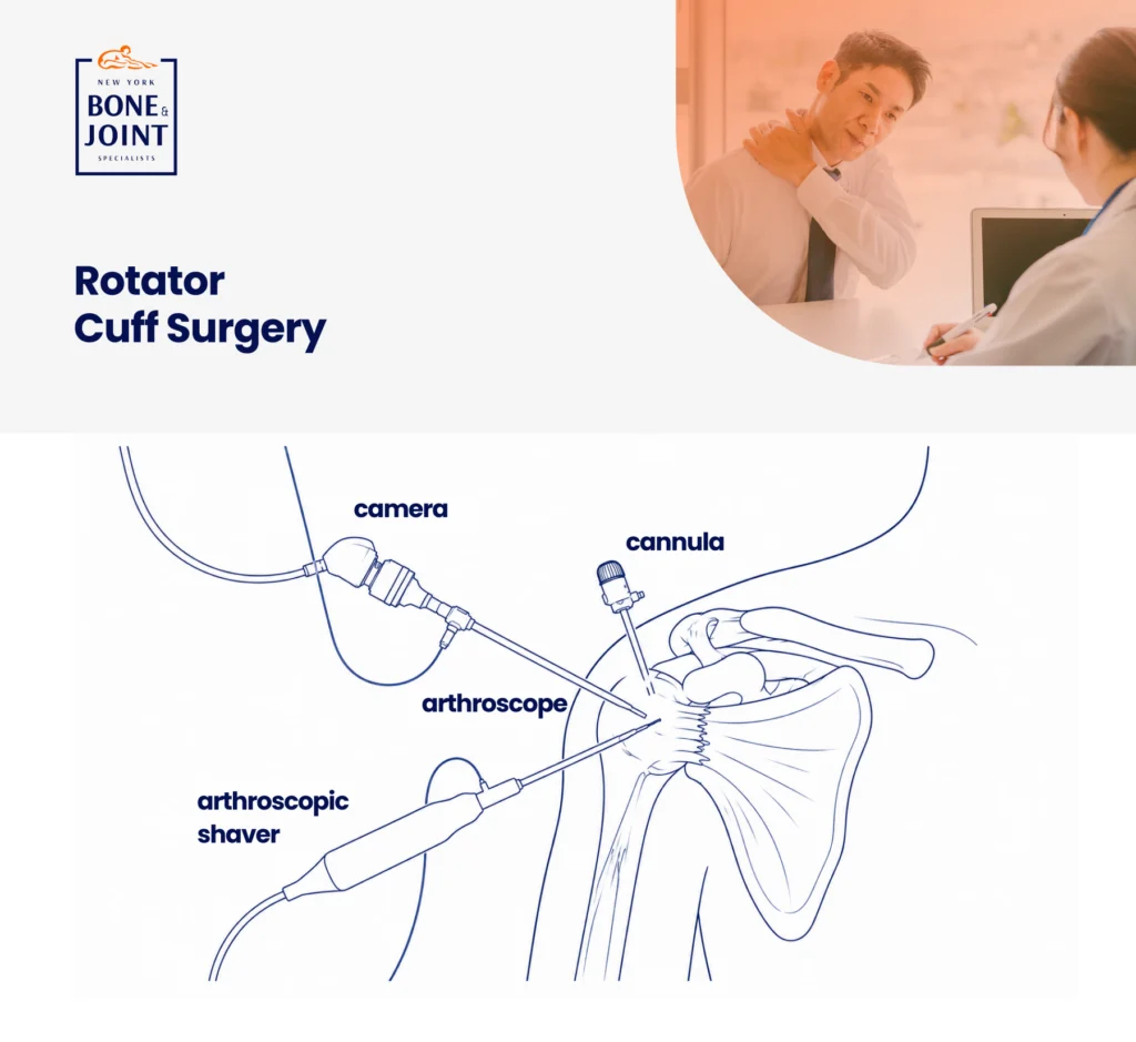 Rotato cuff surgery graphic