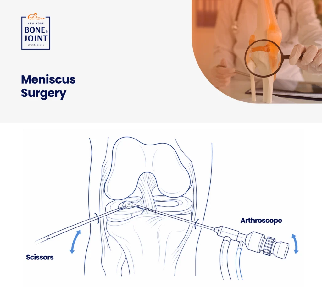 Meniscus Surgery Graphic