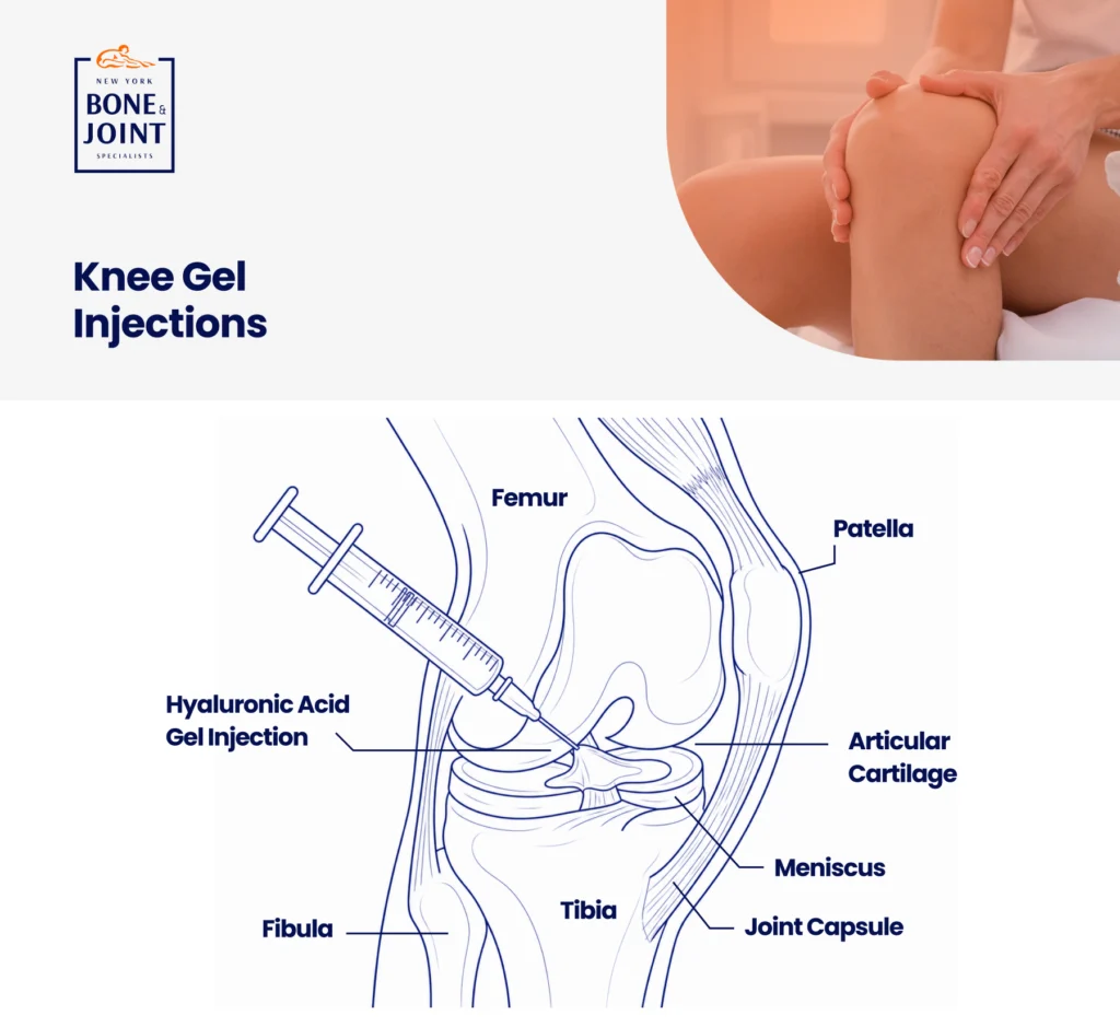 Knee Gel Injections Graphic